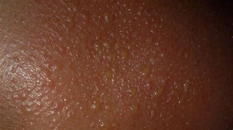 why is my sunburn leaking yellow|Sunburn Blisters: Symptoms, Treatments, and Complications